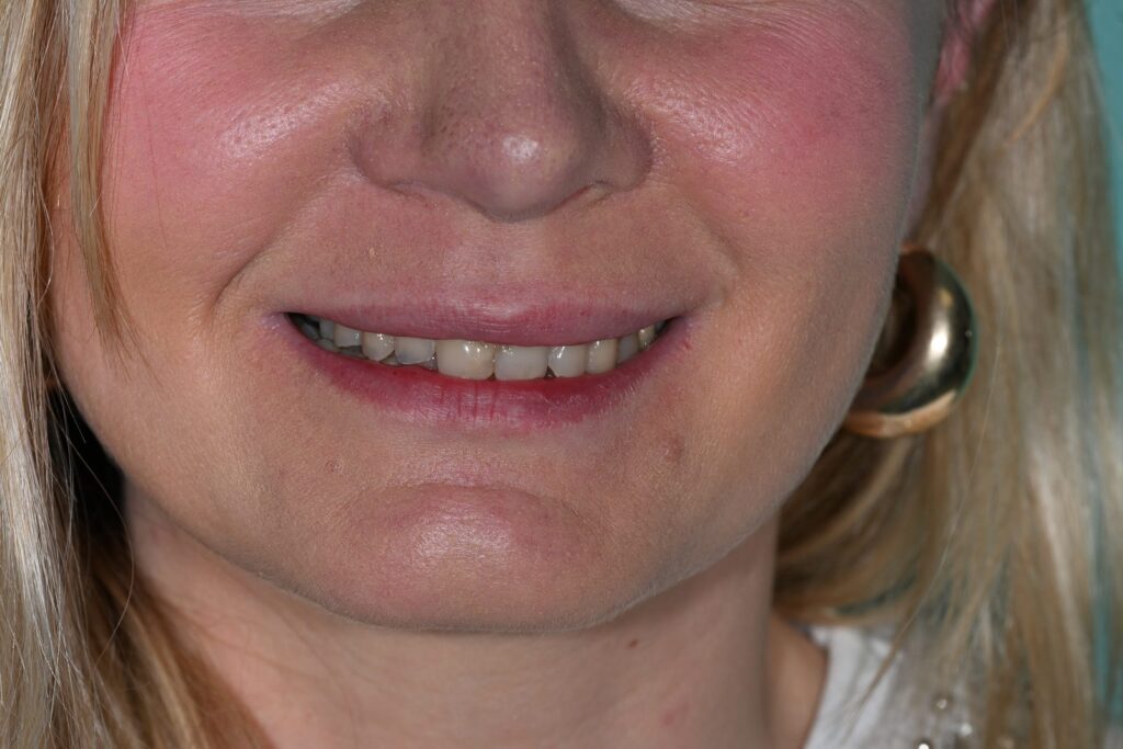Caso clinico faccette estetiche, fase 1