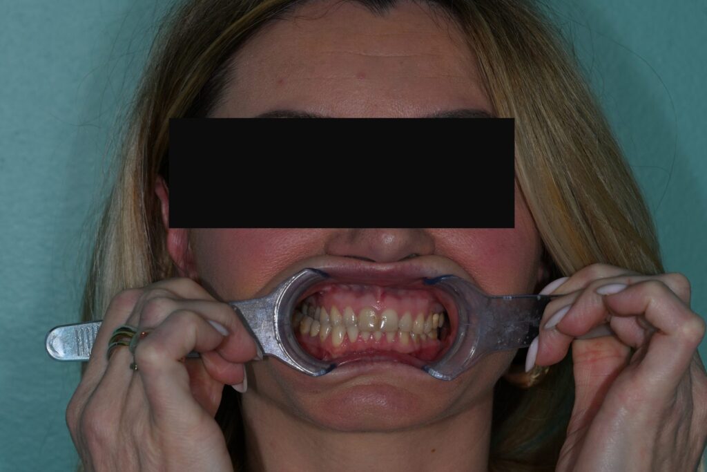 Caso clinico faccette estetiche, fase 2
