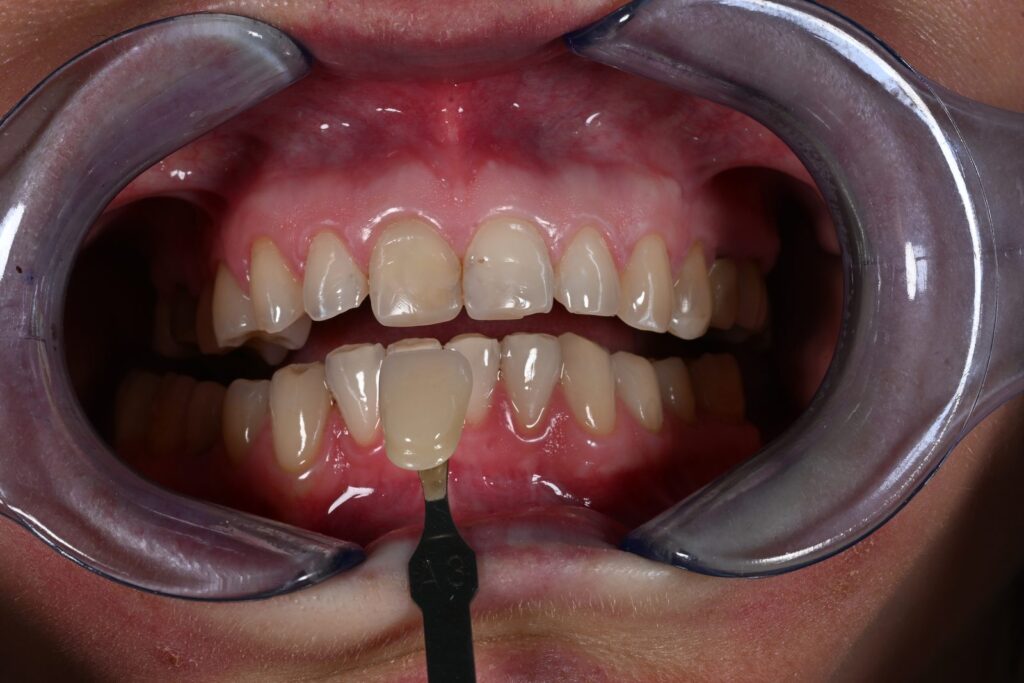 Caso clinico faccette estetiche, fase 3