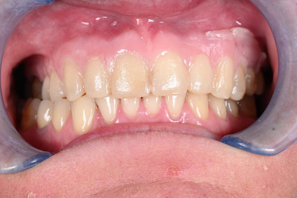 Caso clinico faccette estetiche, fase 4