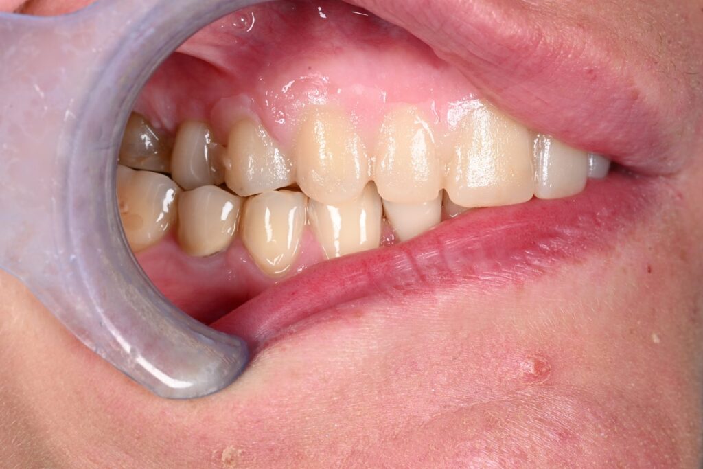 Caso clinico faccette estetiche, fase 5