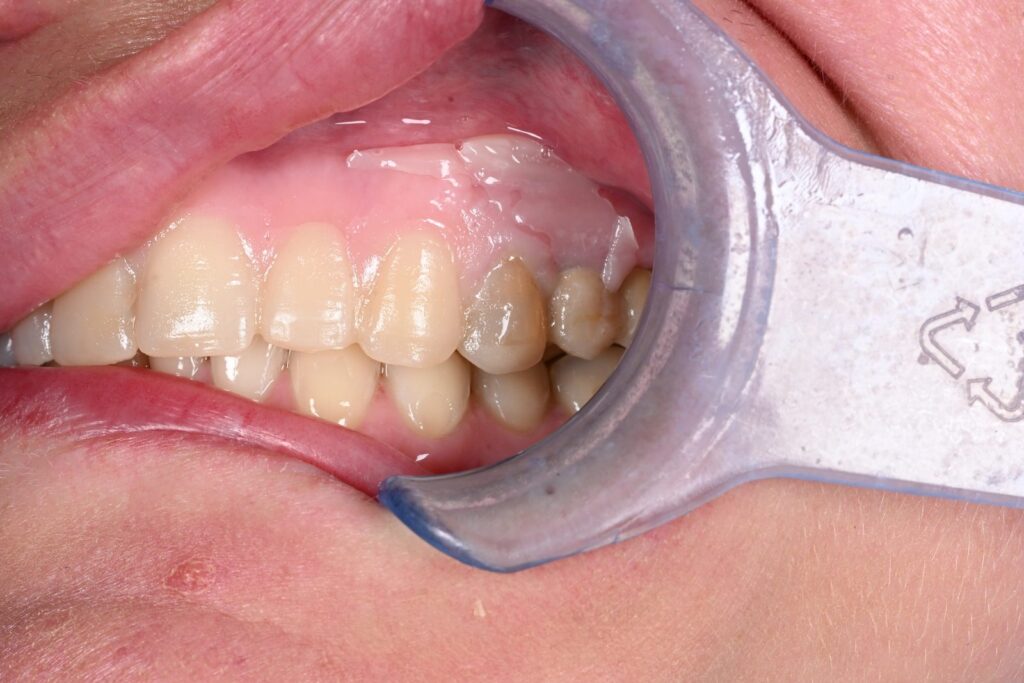 Caso clinico faccette estetiche, fase 6