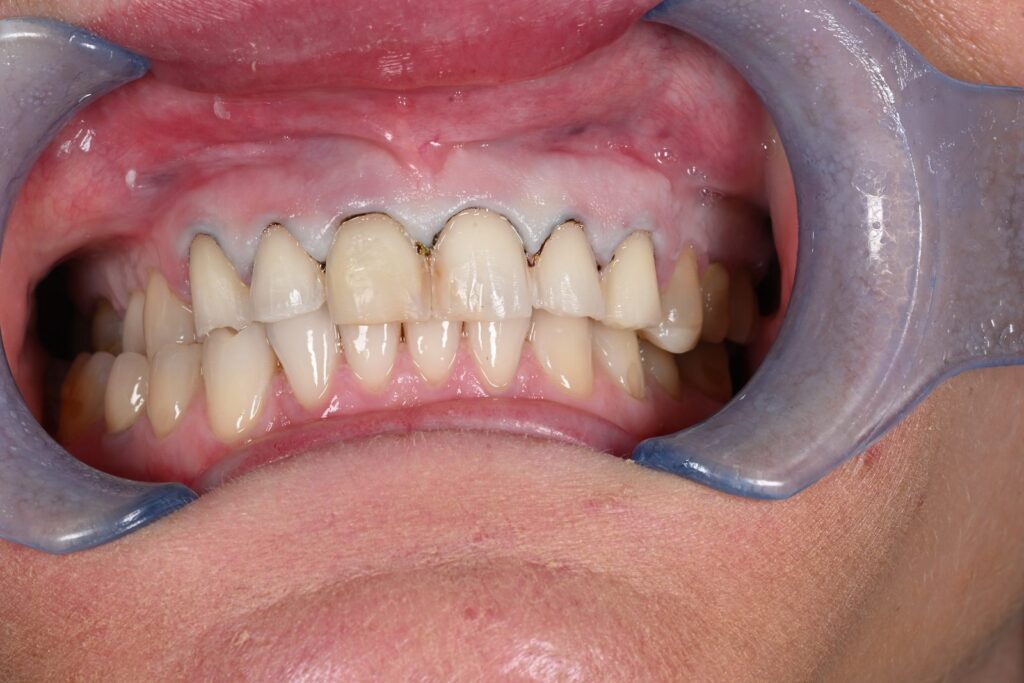 Caso clinico faccette estetiche, fase 7