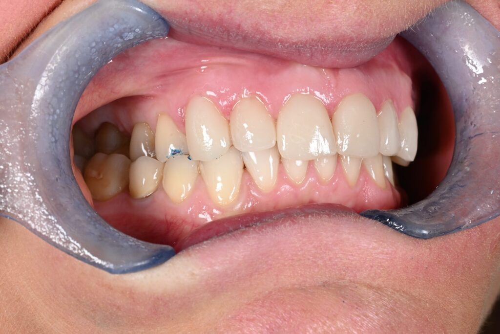 Caso clinico faccette estetiche, fase 9
