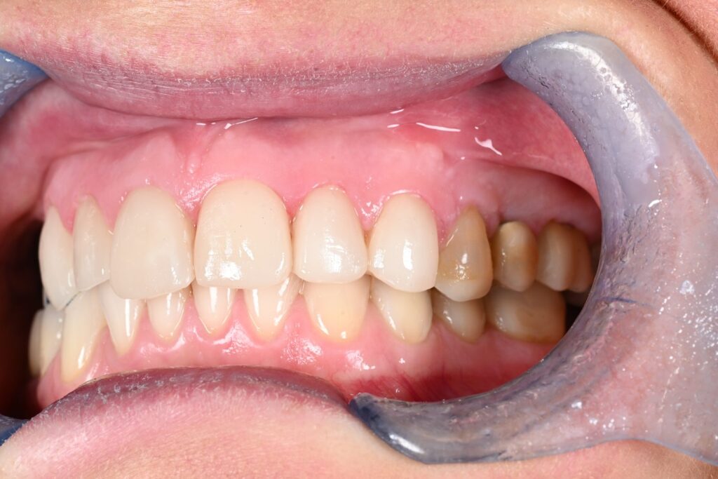 Caso clinico faccette estetiche, fase 10