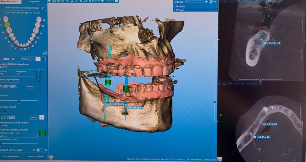 Software di pianificazione implantare 3D per la chirurgia guidata