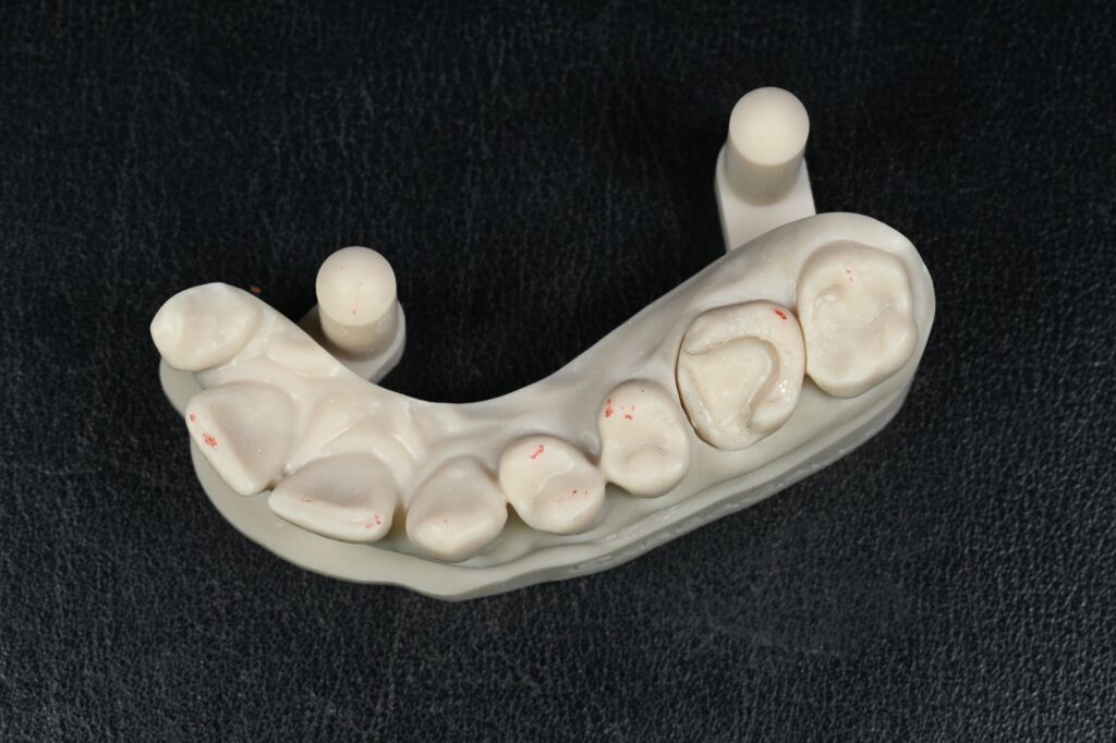 Preparazione del dente che riceverà l’intarsio in ceramica
