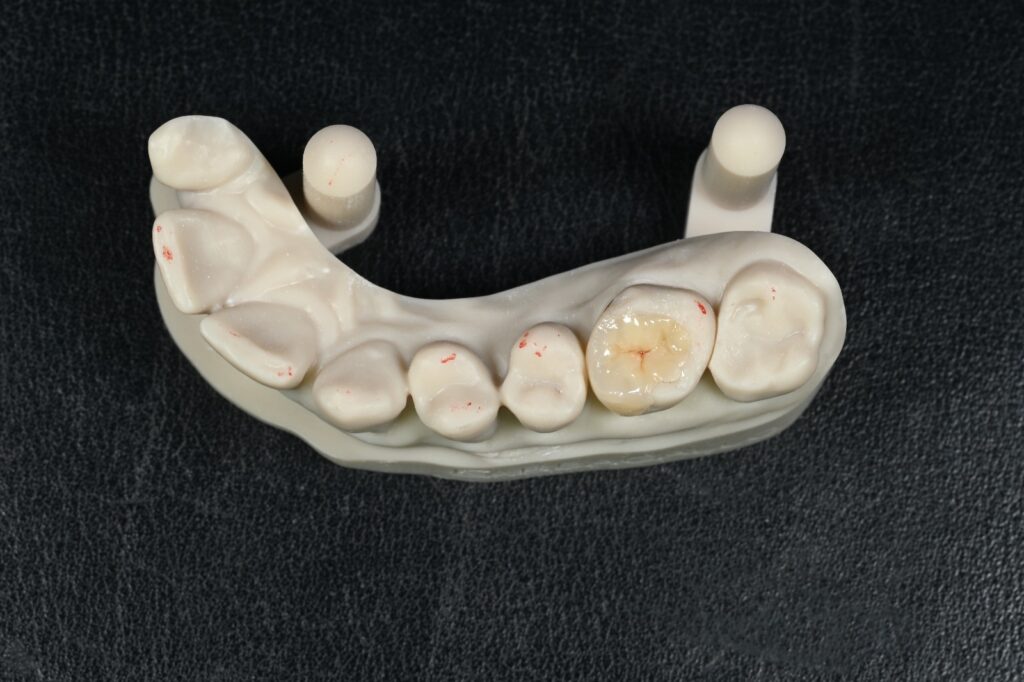Intarsio in ceramica sul modello, prima della cementazione