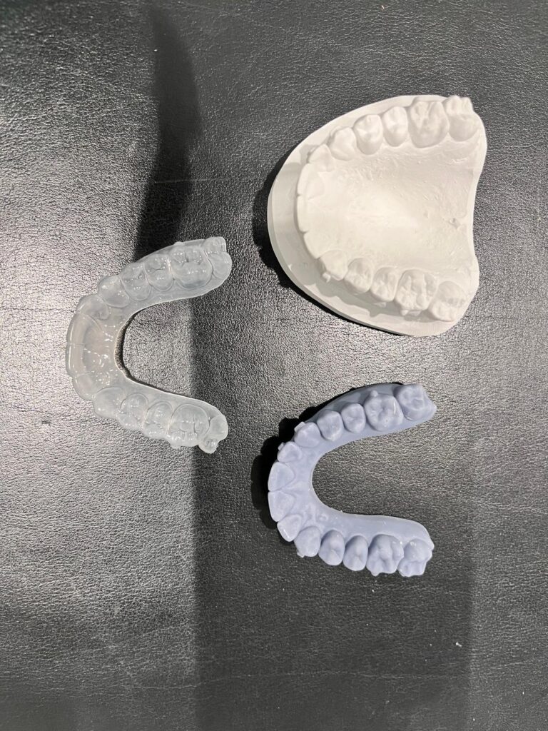 Allineatori trasparenti con i modelli in gesso delle arcate